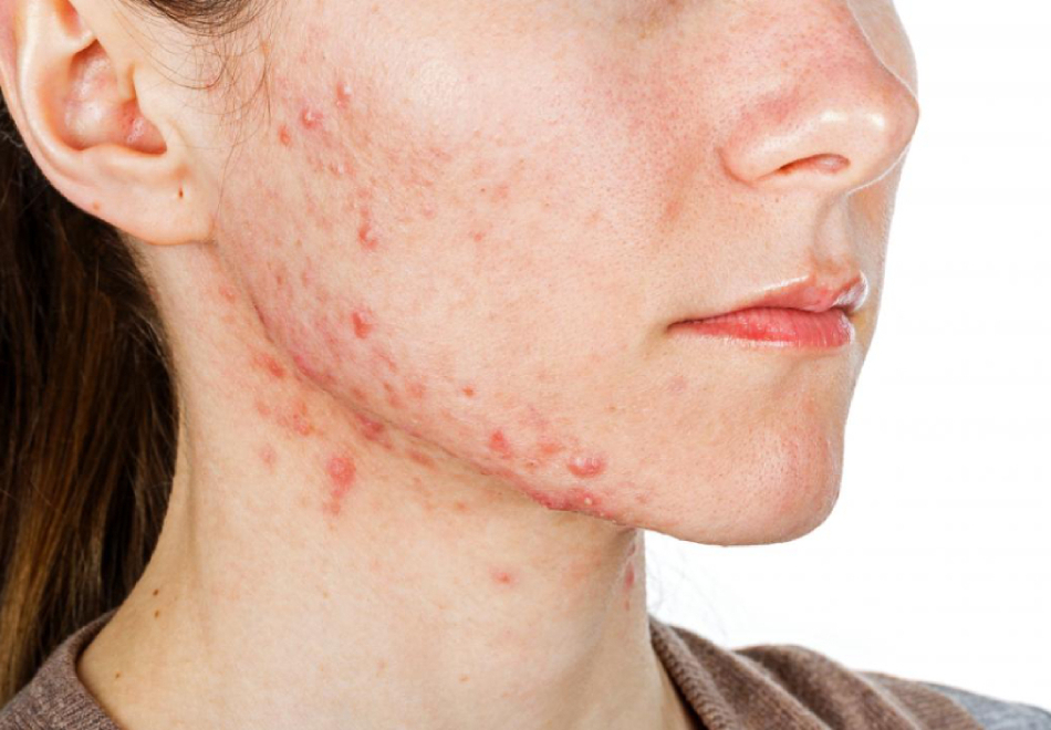 1jawline acne 1
