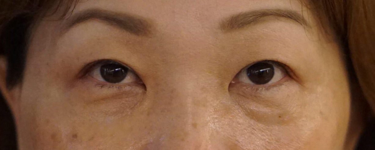 eye bag singapore