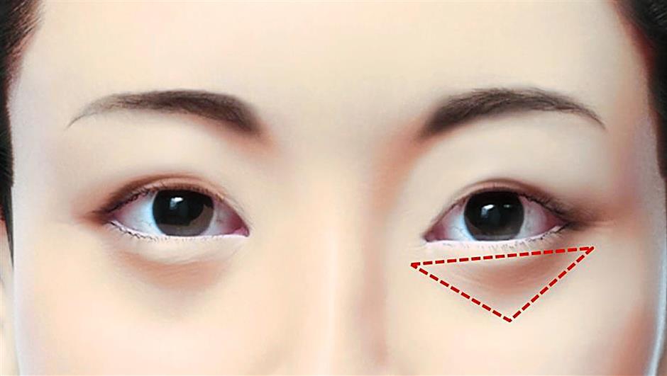 dark eye circles removal