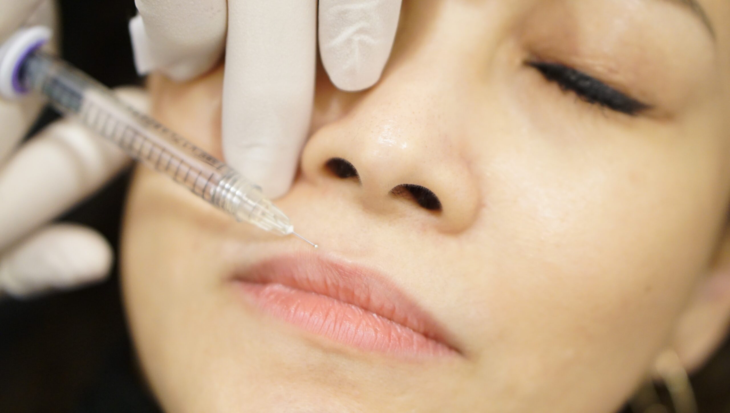 Lip Fillers in Singapore, Dr Gerard Ee, Singapore