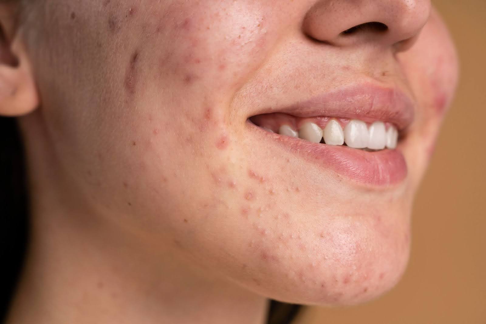 acne scars and surgical scars