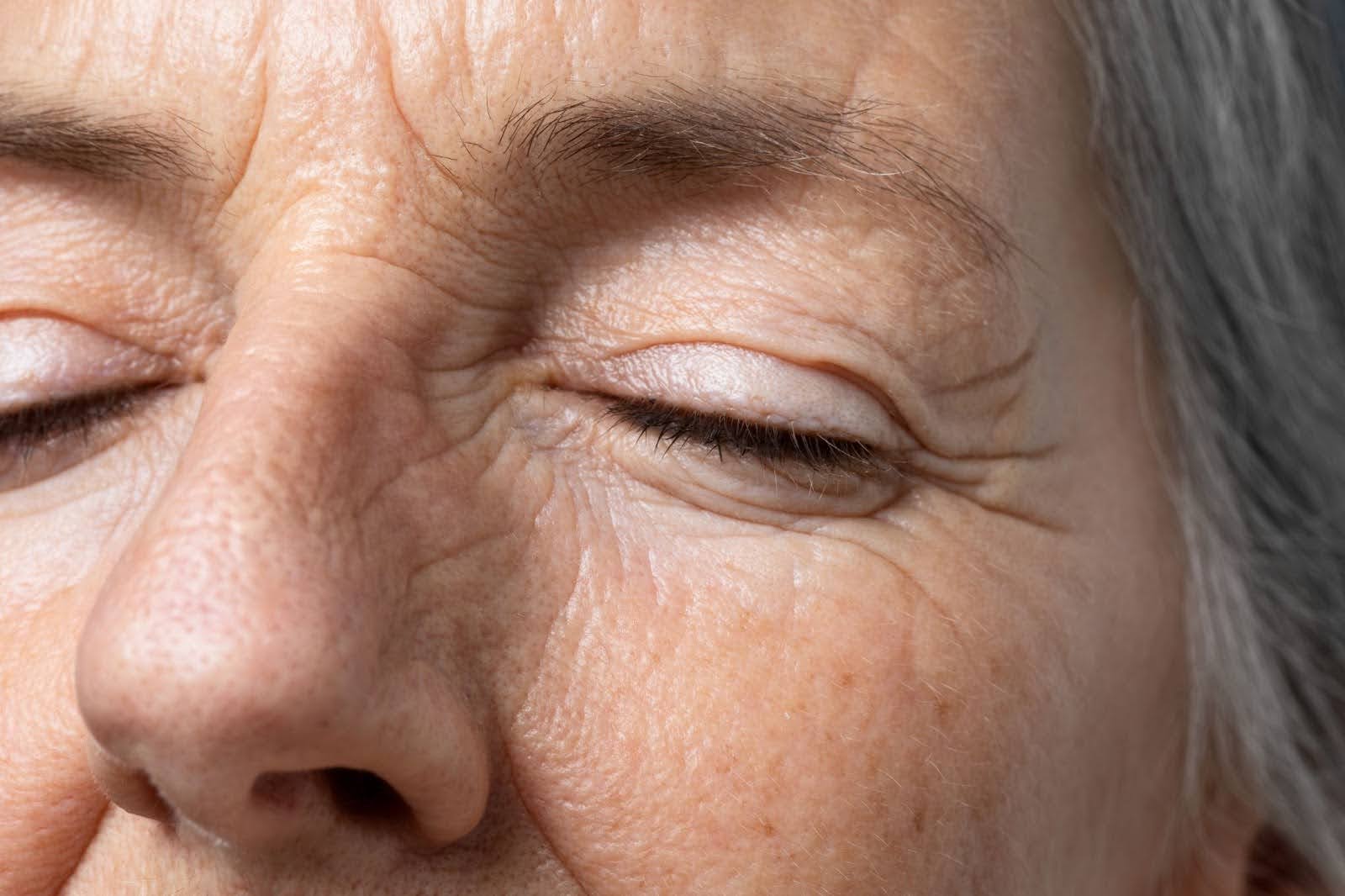 fine lines and wrinkles