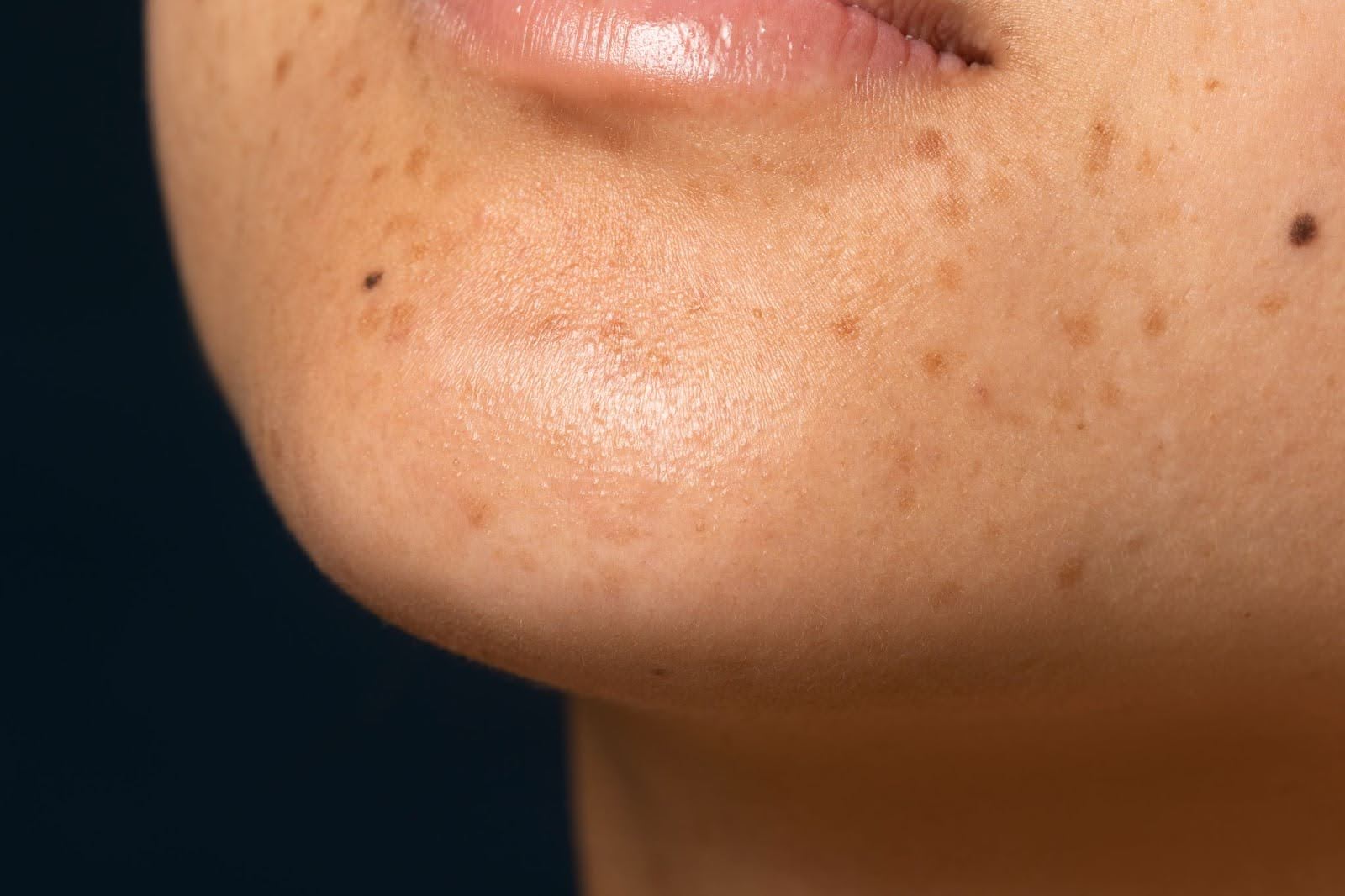 pigmentation
