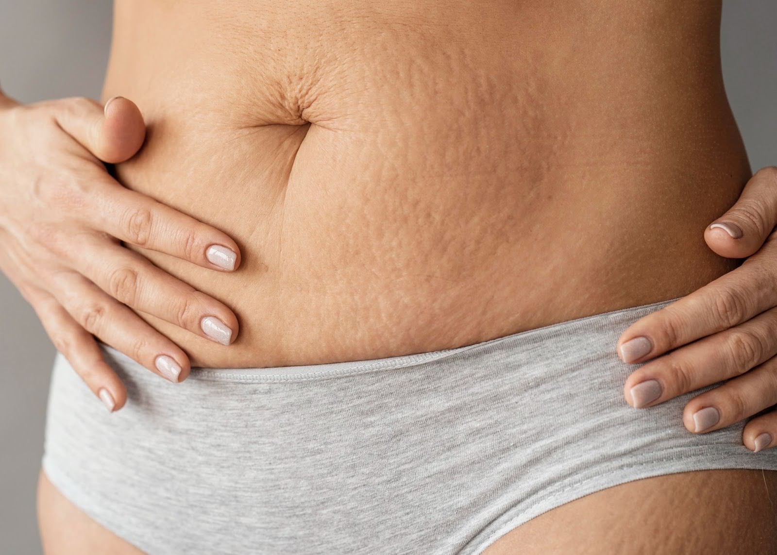 stretch marks