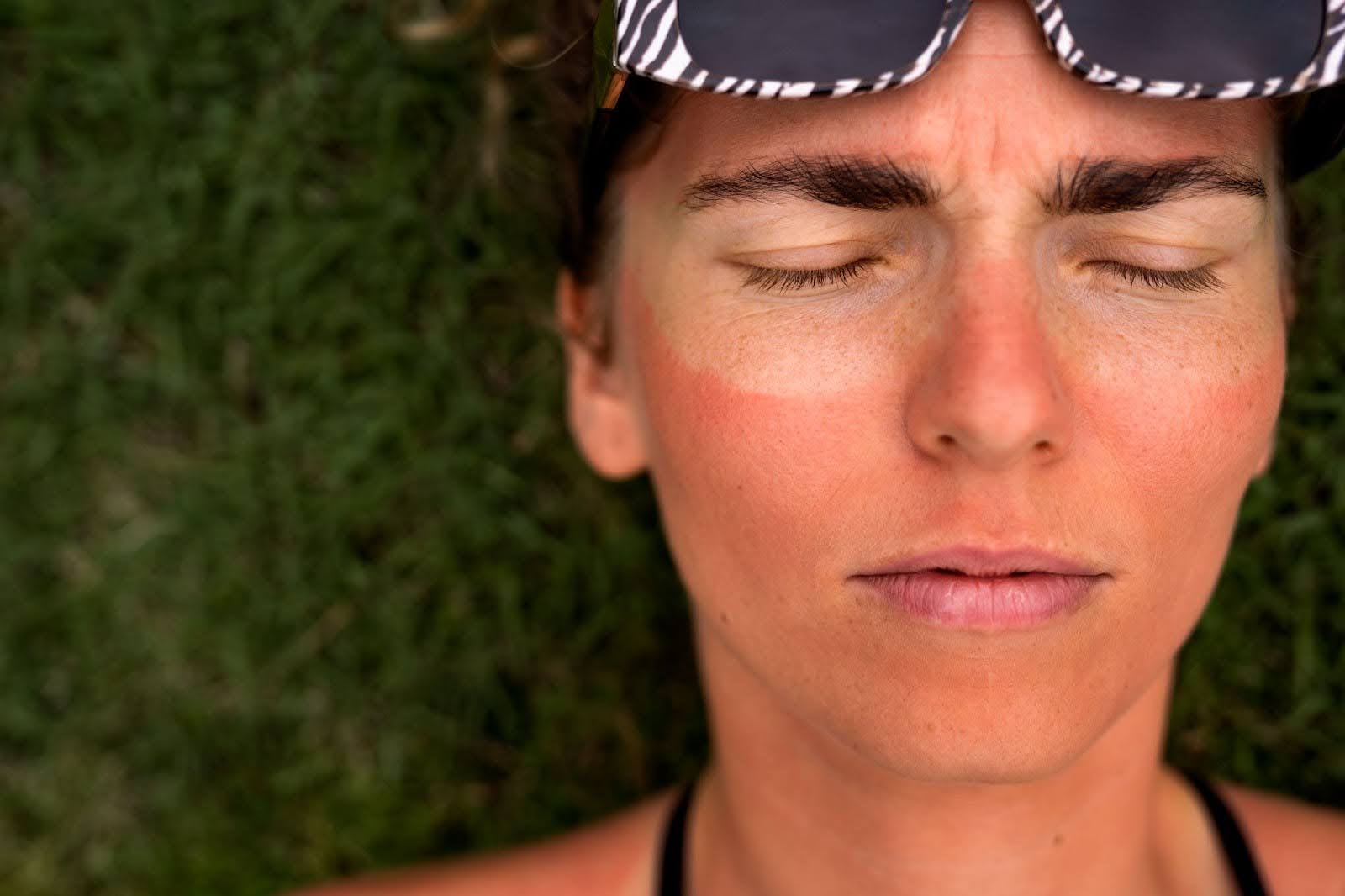 sun damage