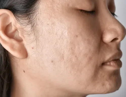 Not Seeing Acne Scar Results from Sylfirm X?