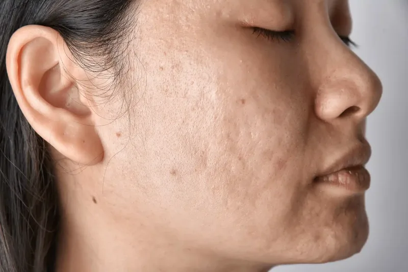 How To Treat Acne Scars 1