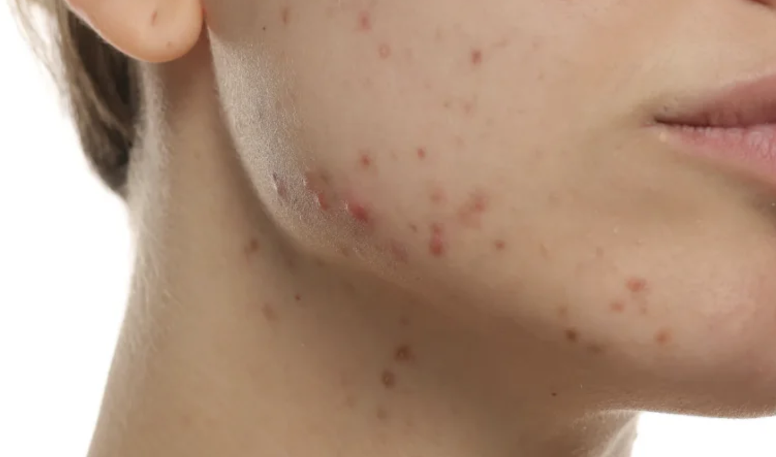 Hormonal Acne