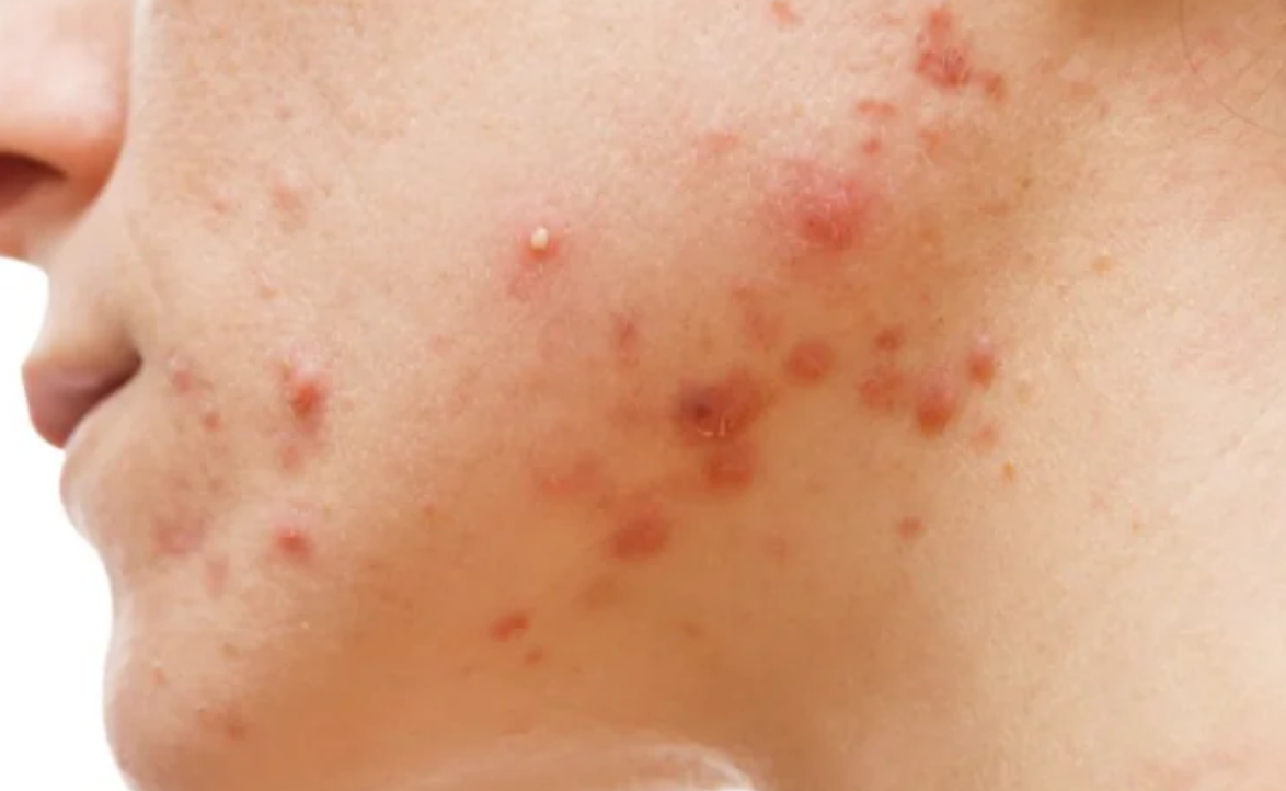 Hormonal Acne