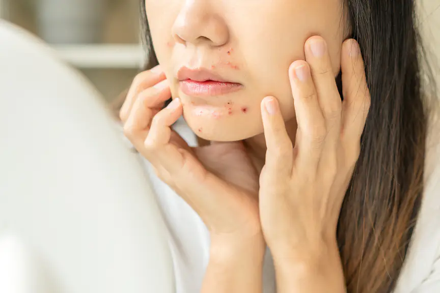 chin acne