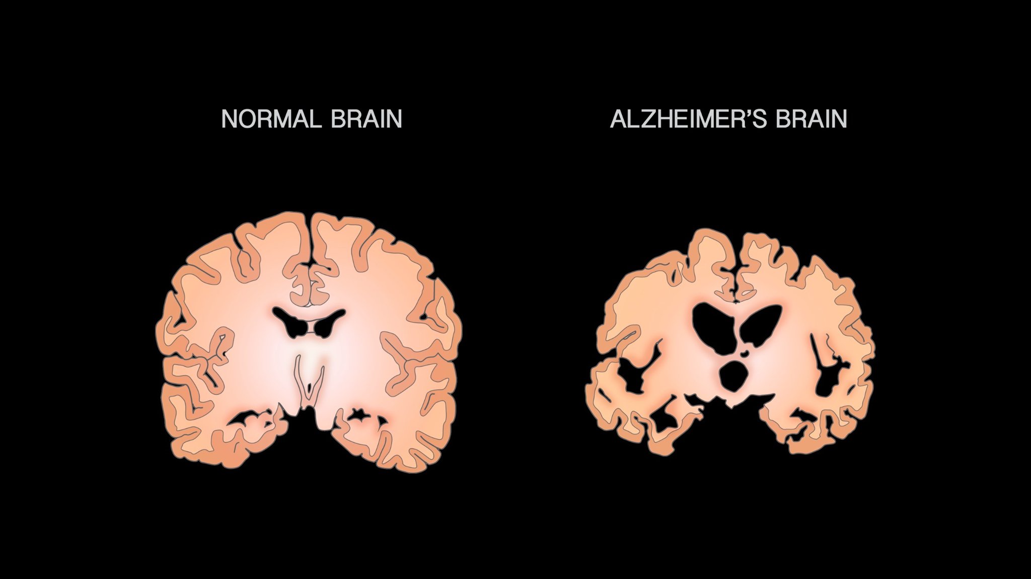 Alzheimer’s disease