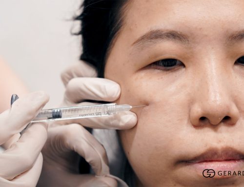 What Is The Best Eye Bag Treatment in Singapore: How I Choose Between Fillers, AGNES, Secret RF and Surgery