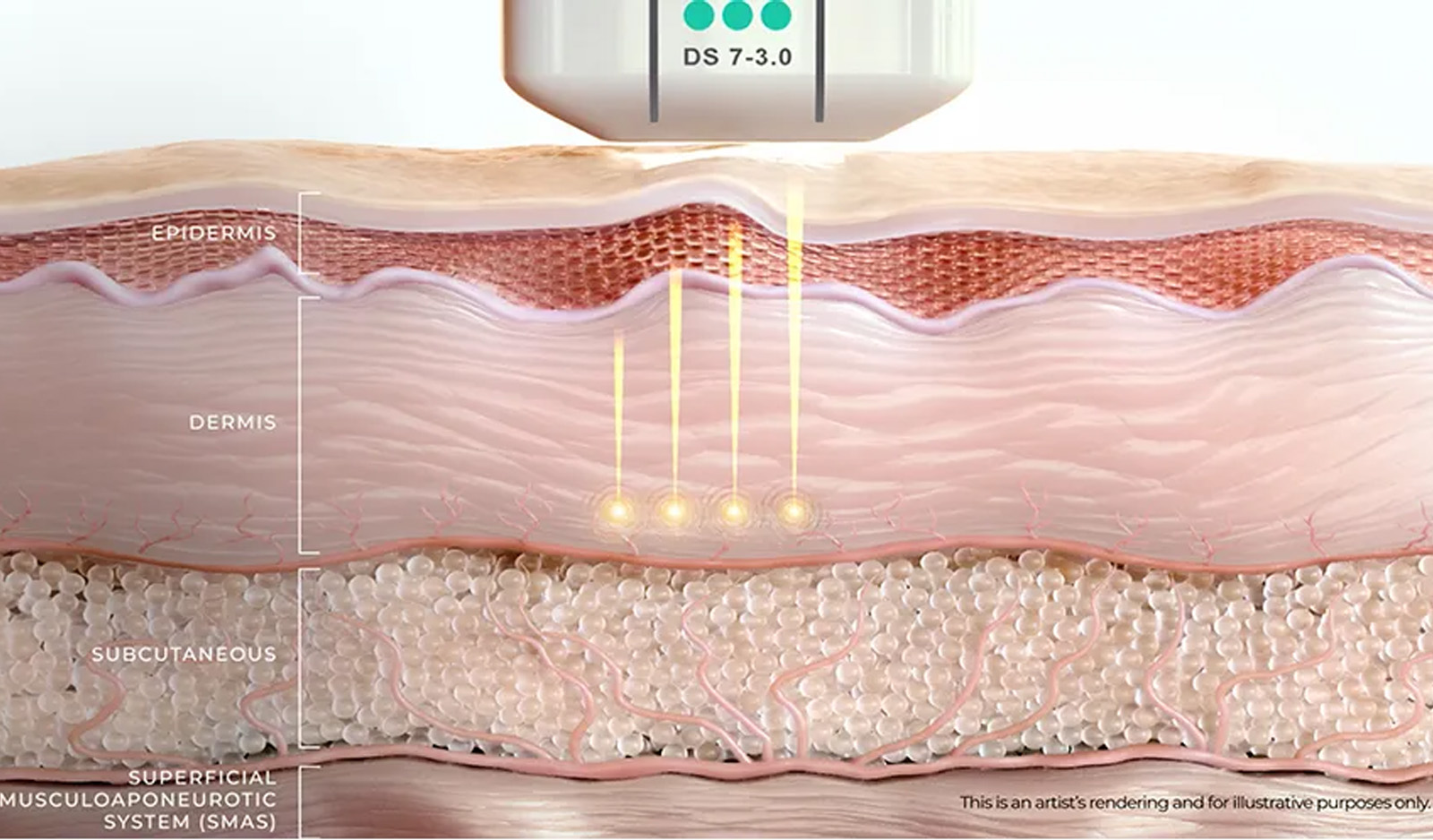 Ultherapy Prime diagram