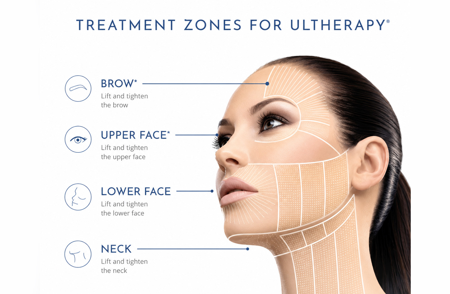 ultherapy zones