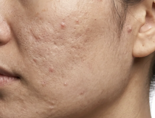 Acne Scars or Pigmentation? How to Tell the Difference