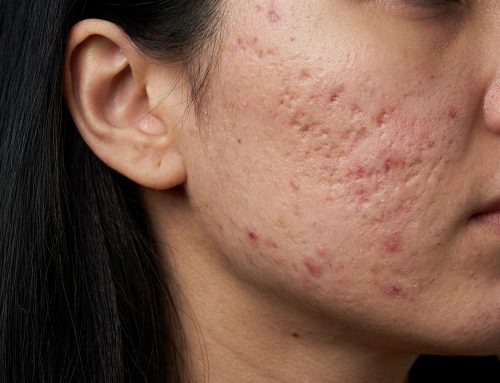 What Causes Acne Scars?