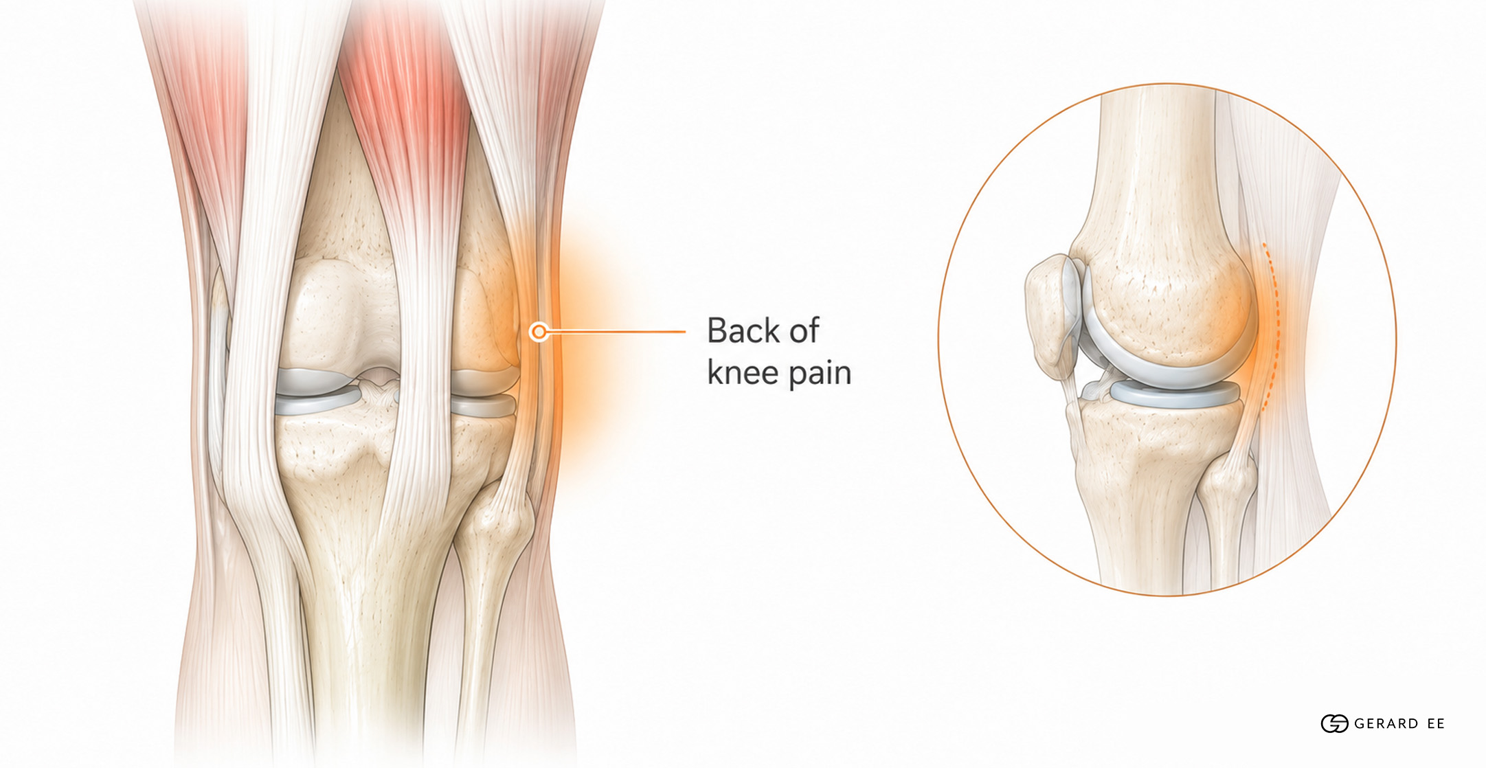 Posterior Knee Pain Posterior Knee Pain