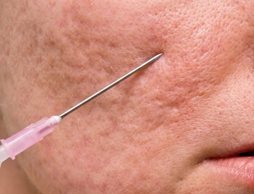 Acne Scar Treatment in Singapore: A Complete Guide