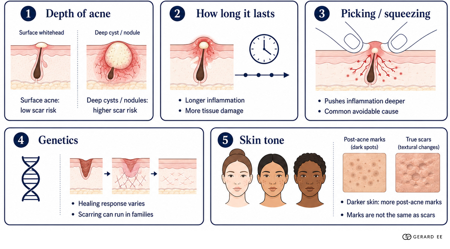 acne causes dge
