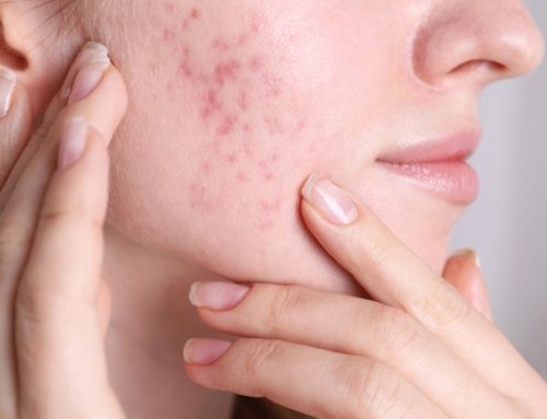 Acne Marks vs Acne Scars: How to Tell PIH, PIE and True Scarring Apart