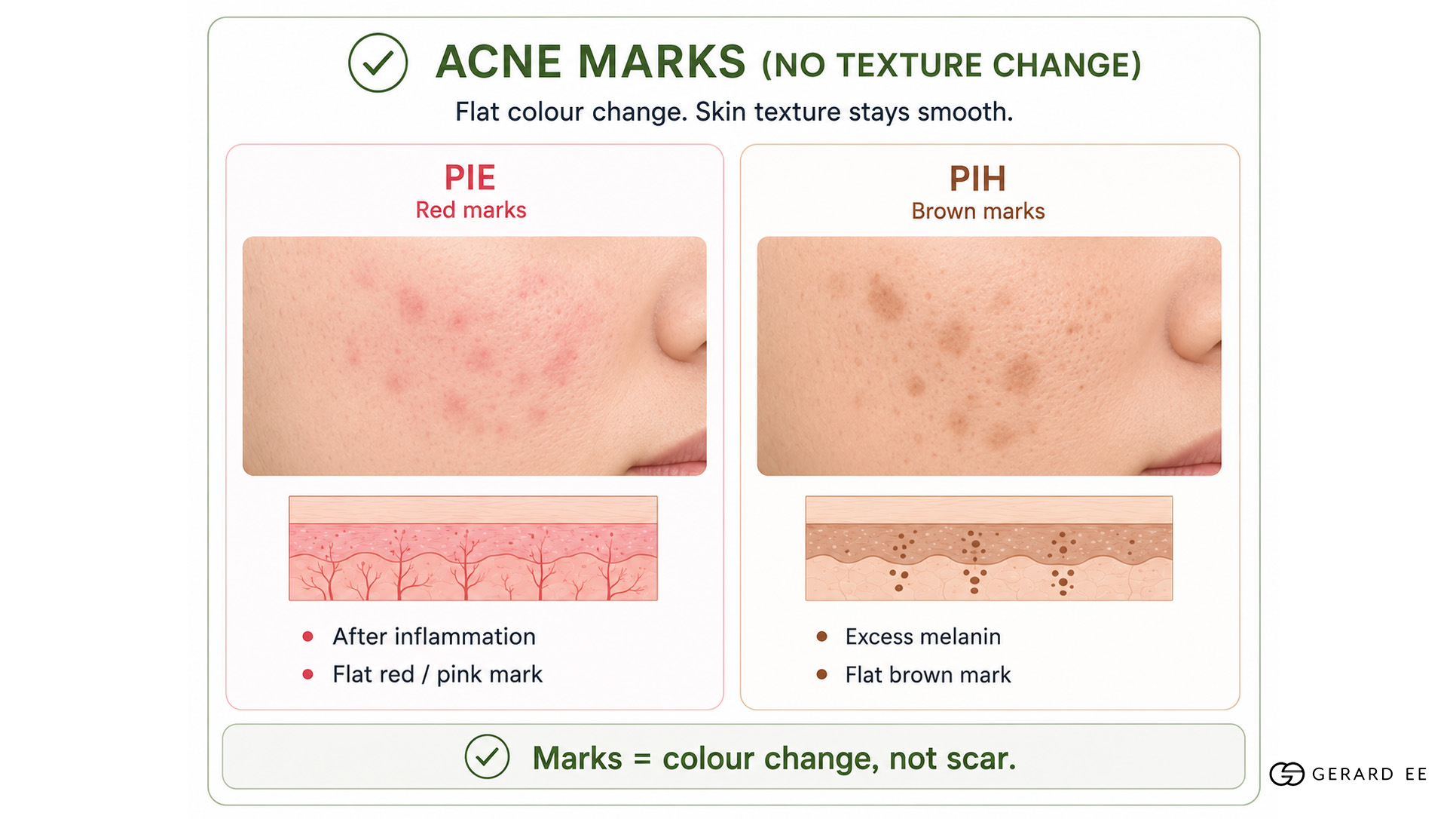 acne marks explanation acne marks explanation
