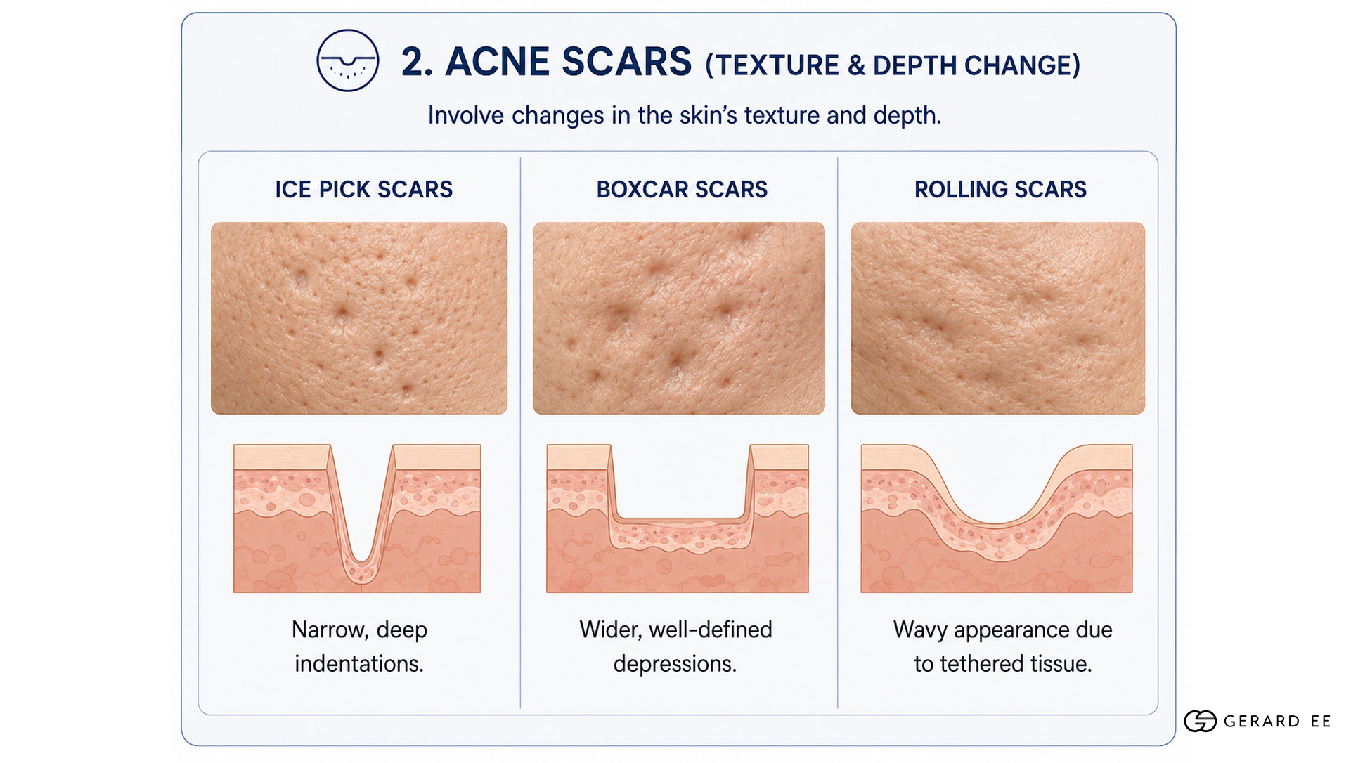 acne marks explanation 2 acne marks explanation 2