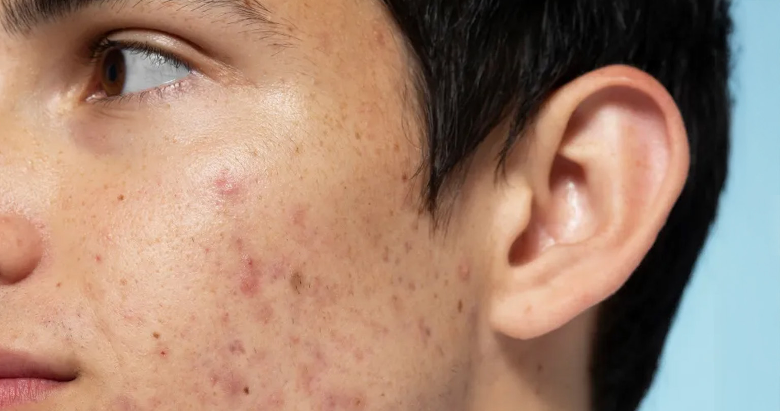 acne marks scar types acne marks scar types