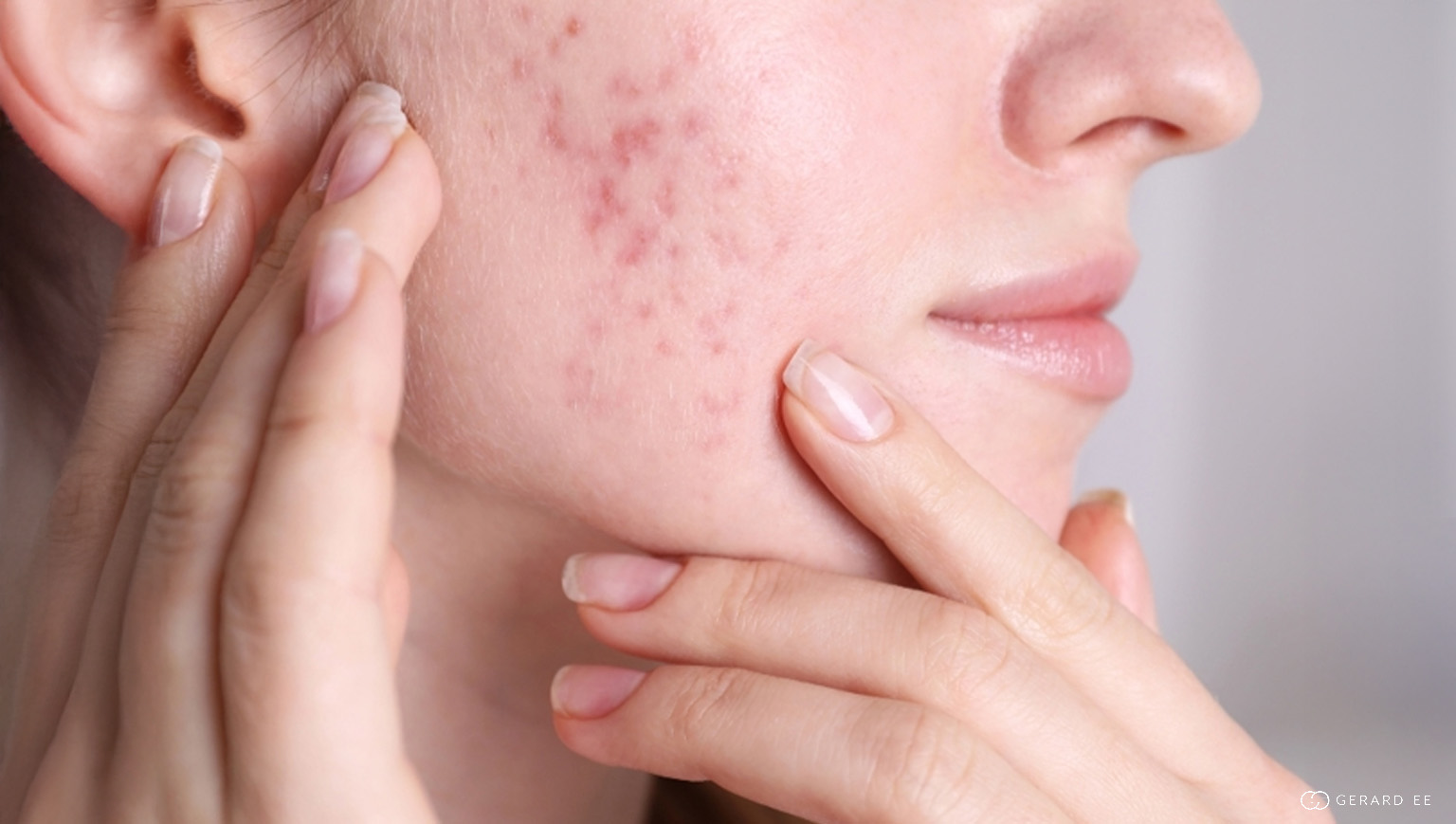 acne marks acne marks
