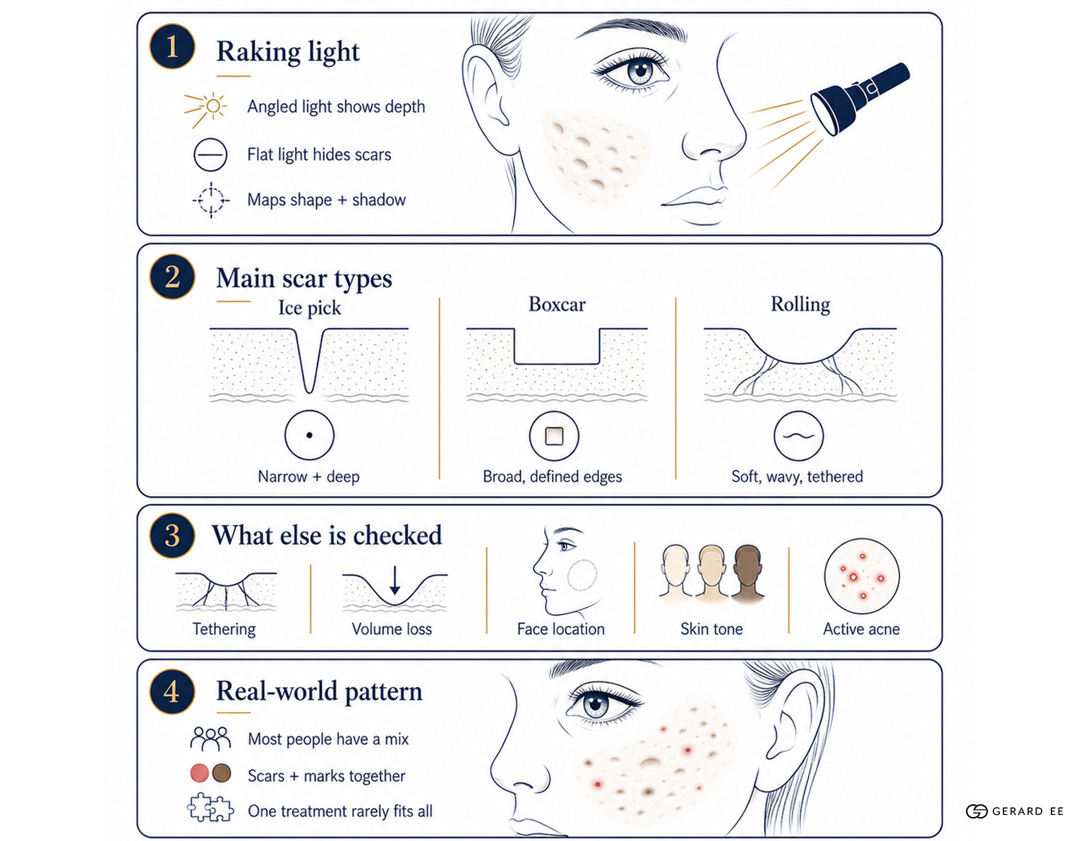 acne scar mapping