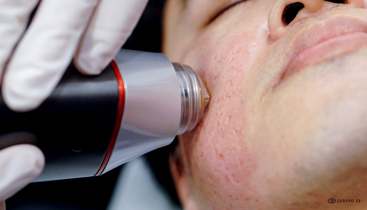 acne scar treatment singapore 2 dge