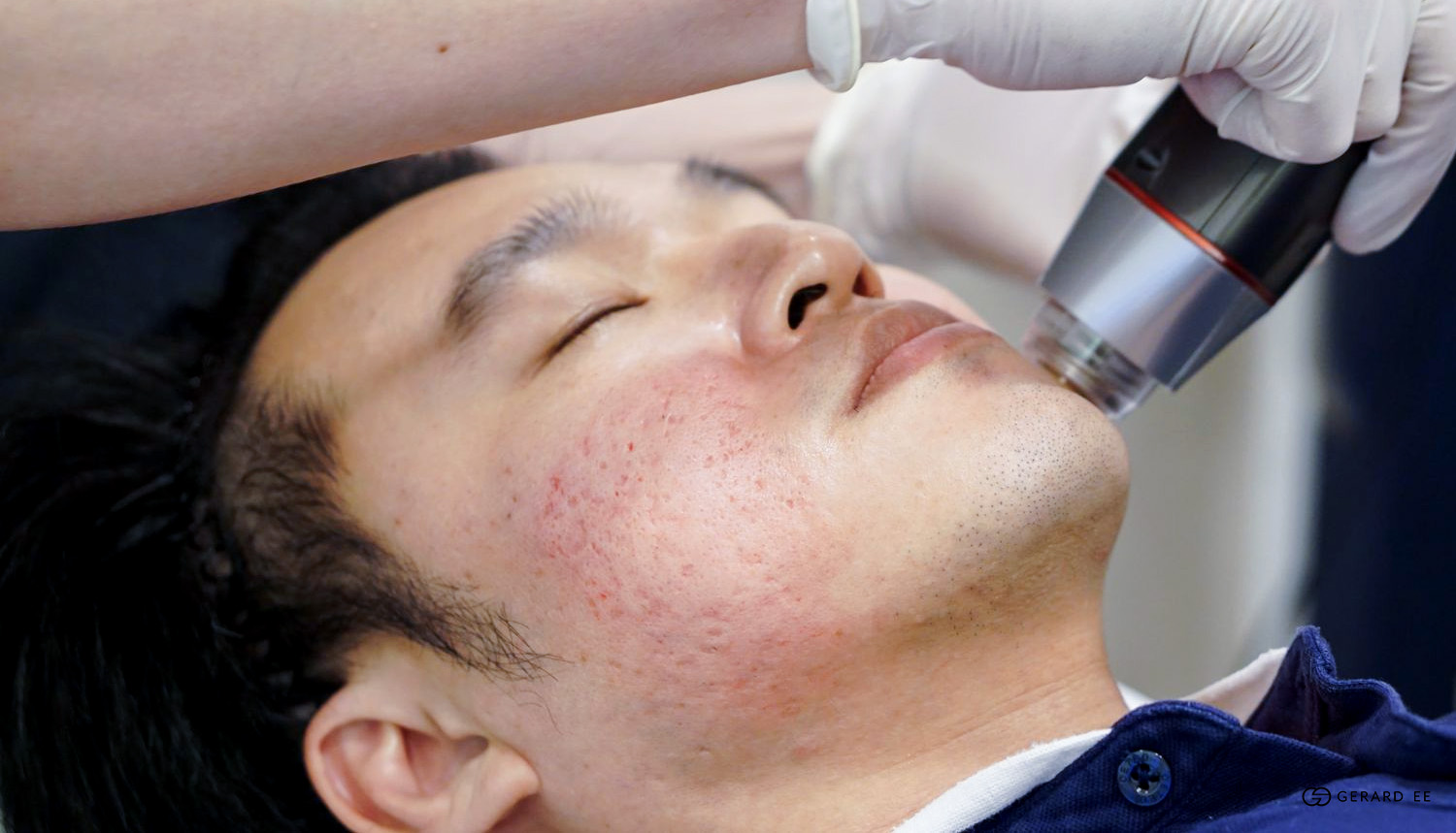acne scar treatment singapore dge