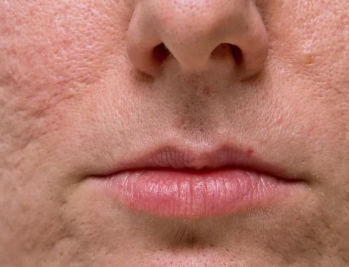Types of Acne Scars and How Each Is Treated