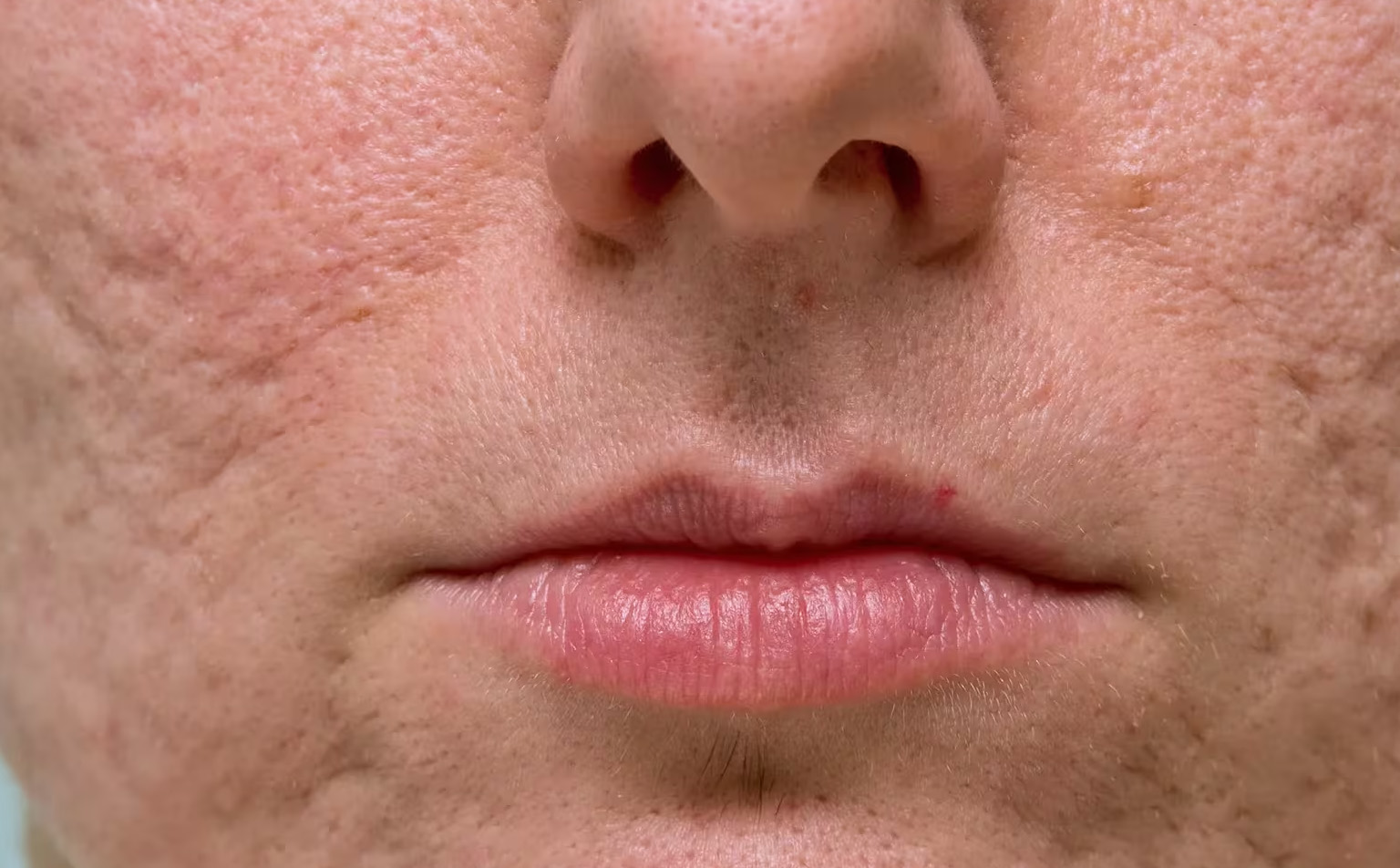 acne scars