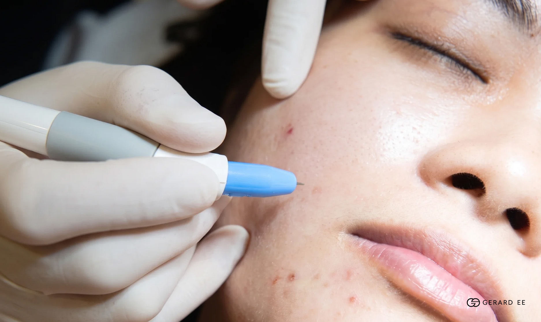 agnes treatment agnes treatment