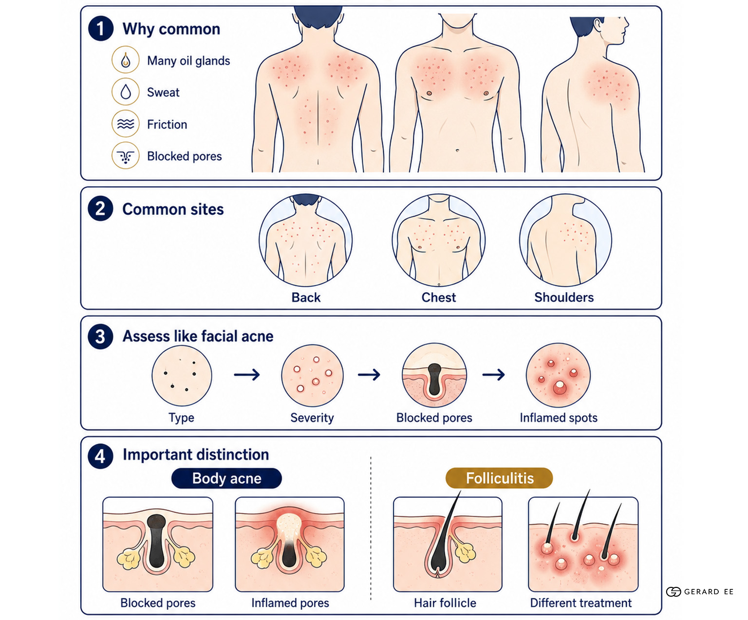body acne diagram body acne diagram