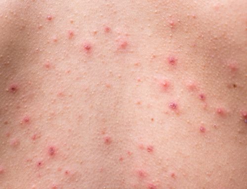Back, Chest and Shoulder Acne (Bacne) Treatment in Singapore