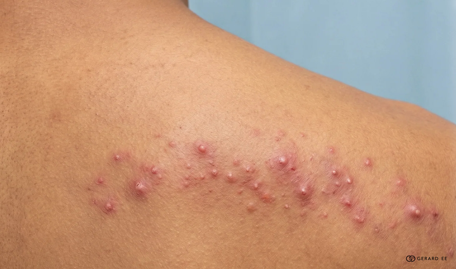 body acne body acne