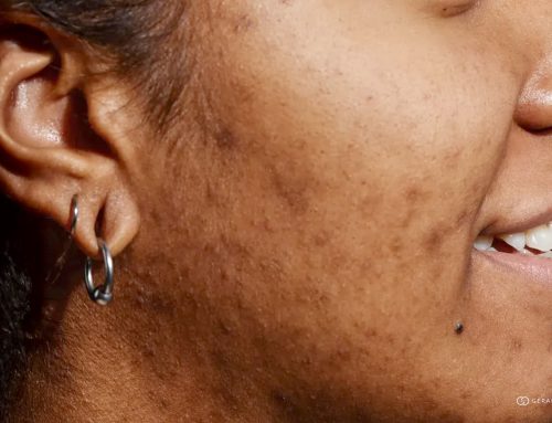 Brown Acne Marks (PIH): Pigmentation Treatment for Asian Skin
