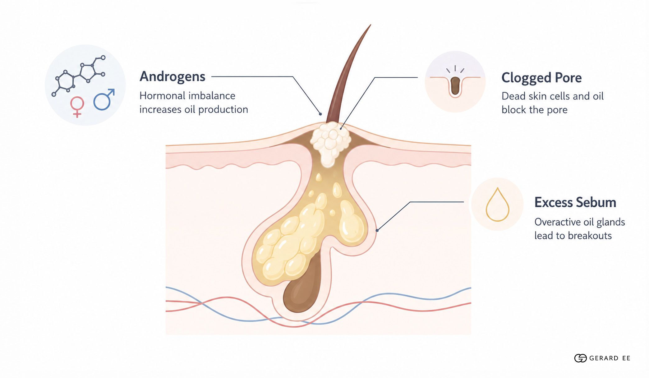 causes of hormonal acne causes of hormonal acne