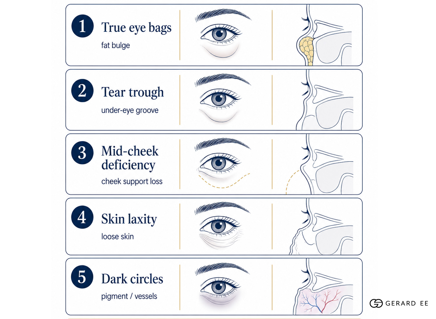 eyebag causes eyebag causes