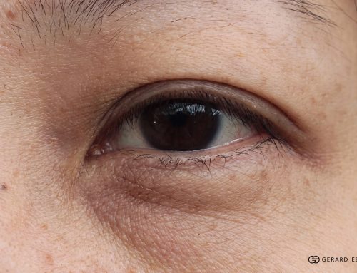 Is Non-Surgical Eye Bag Removal Permanent? A Doctor’s Honest Explanation