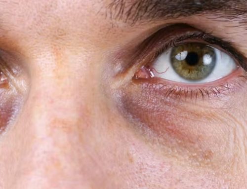Eye Bags vs Tear Troughs: A Doctor Explains the Difference