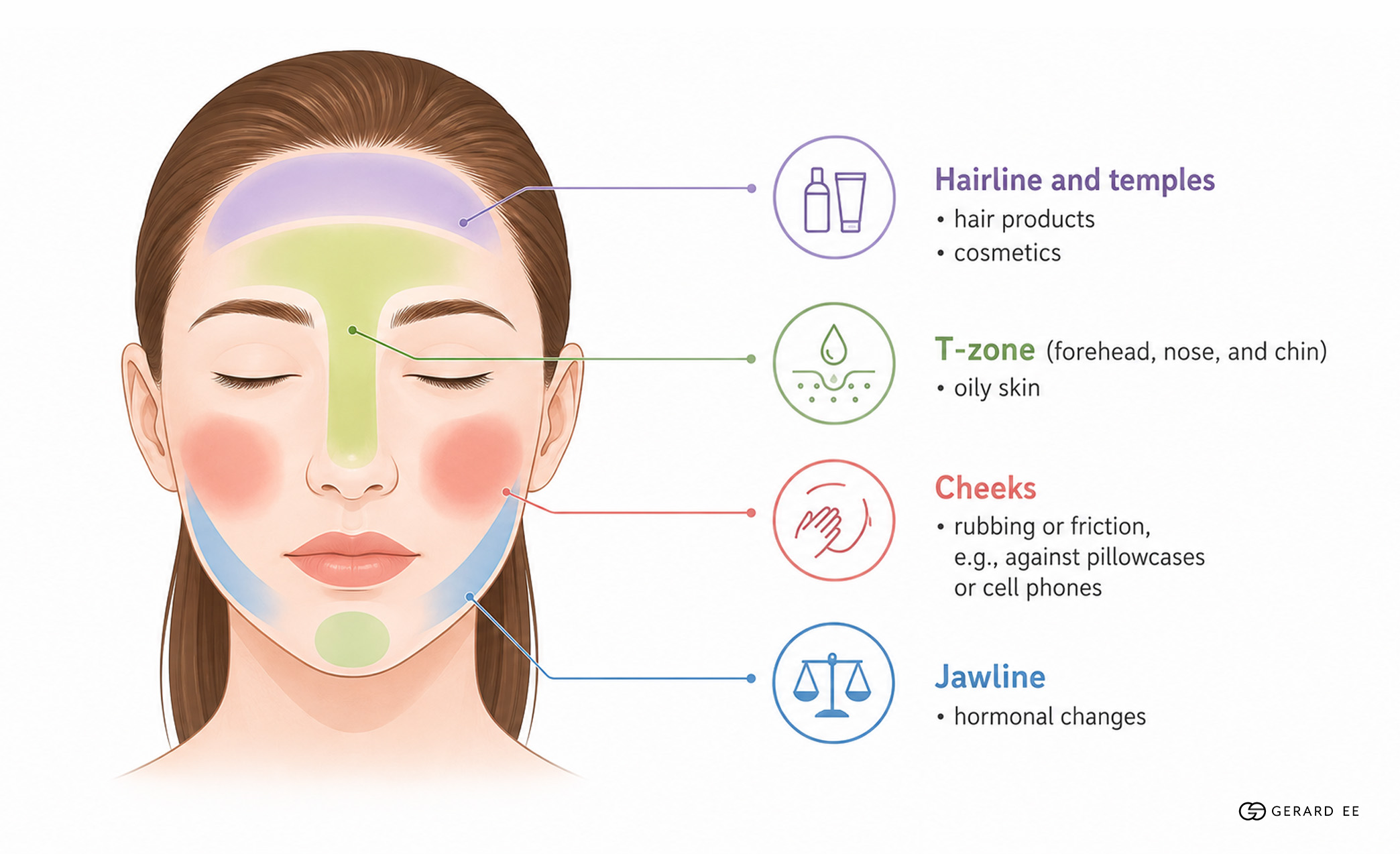 hormonal acne diagram hormonal acne diagram