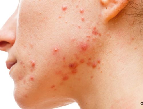 Hormonal Acne in Women: Jawline Acne, PCOS Clues and Treatment Options
