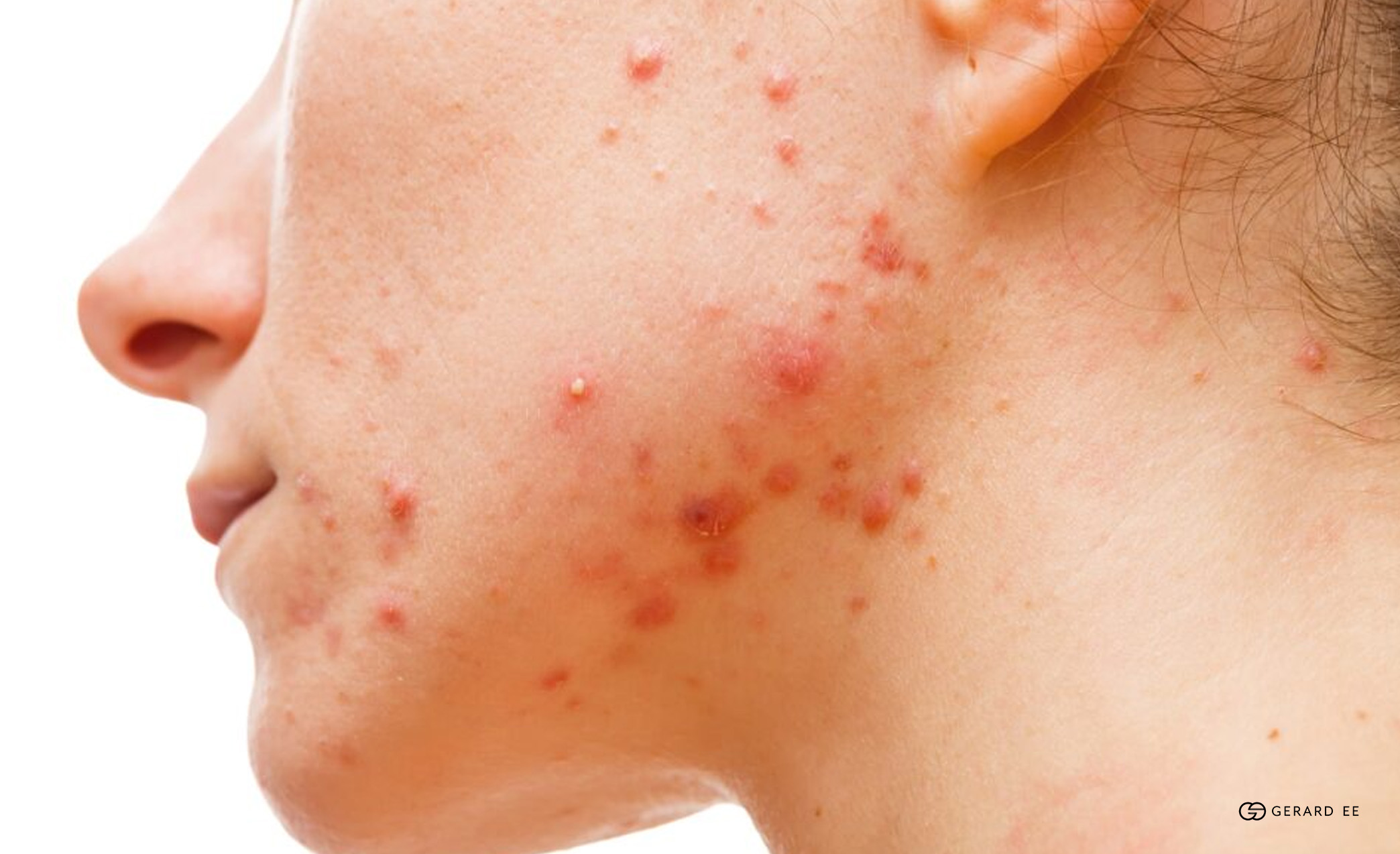 hormonal acne woman hormonal acne woman