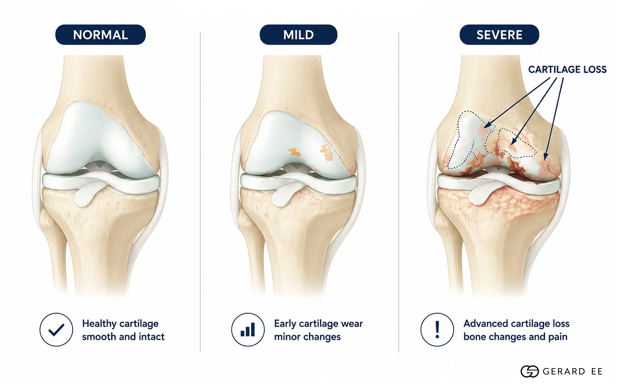 knee osteoarthritis dge knee osteoarthritis dge