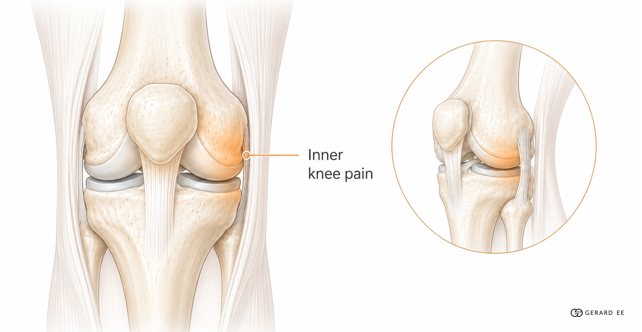 medial knee pain medial knee pain