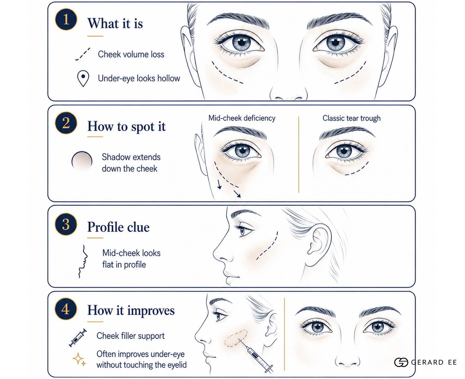 midcheek deficiency midcheek deficiency