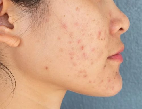 Lasers for Acne Marks: Vbeam, Q-Switch and Acne-Stabilising Lasers