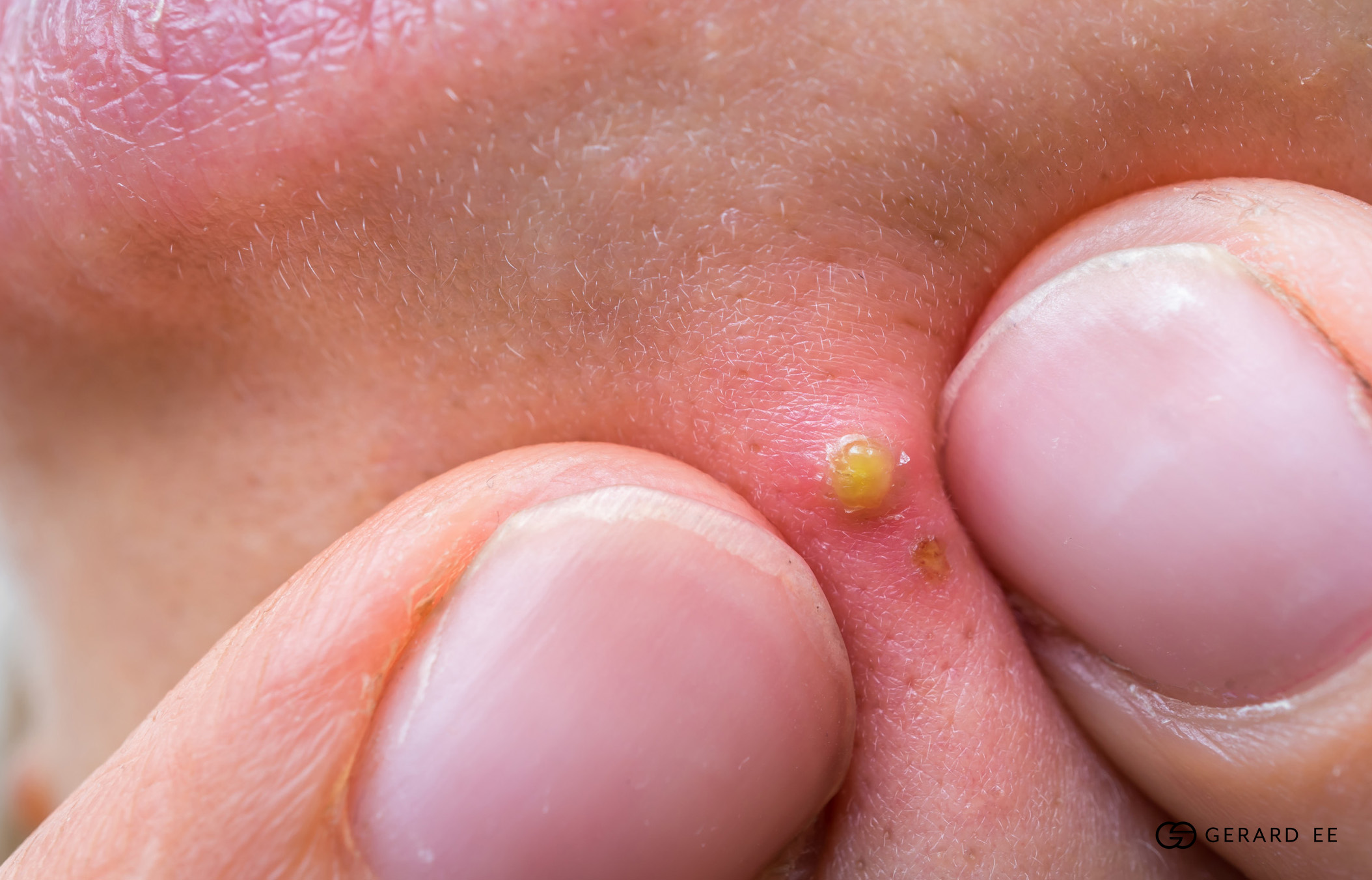 squeezing pimple dge squeezing pimple dge